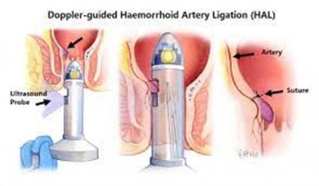 ligature doppler Aix-en-Provence