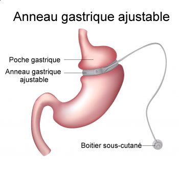 Anneau gastrique