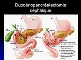 Duodénopancréatectomie céphalique