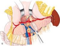 Slénopancreéatectomie gauche